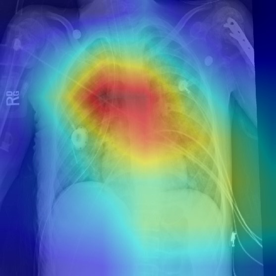 Chest X-ray with a visual analysis heatmap in the Fovea AI diagnostics section